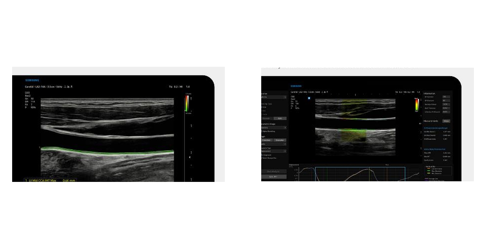 ArterialAnalysis and AutoIMT