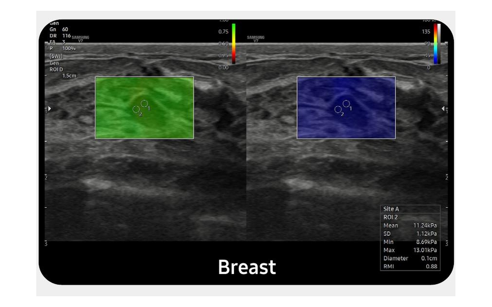 S-Shearwave Imaging